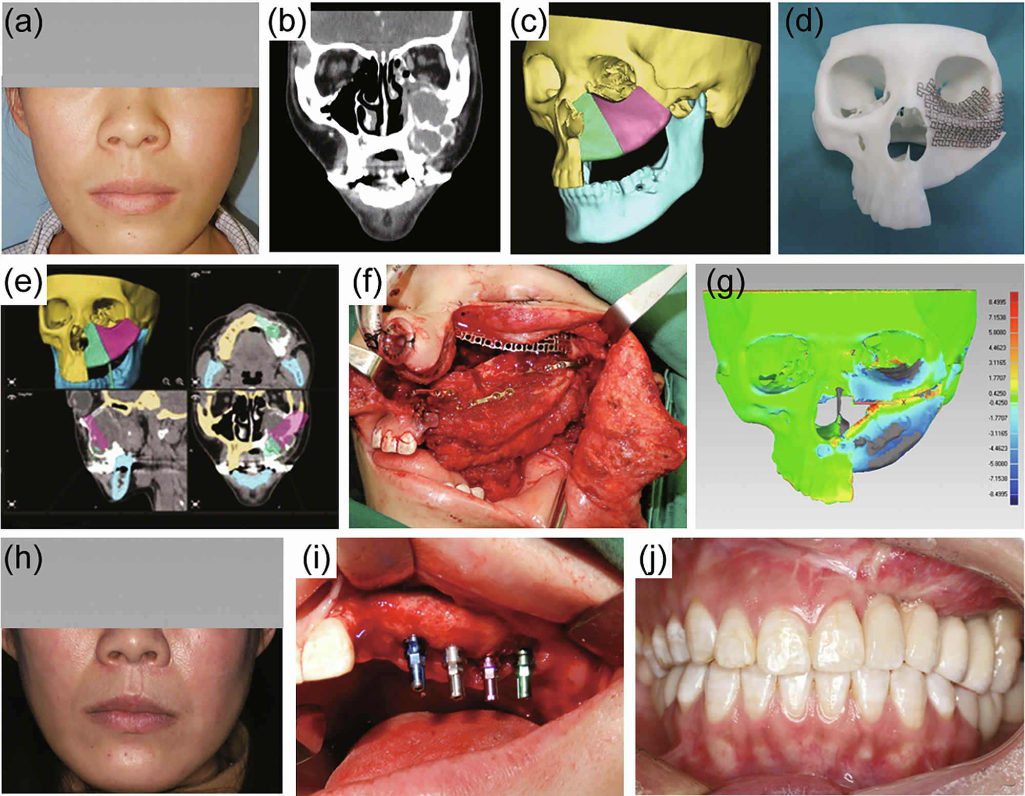 俞光岩、彭歆课题组在数字化技术辅助口腔颌面部肿瘤诊治领域发表专家评介文章